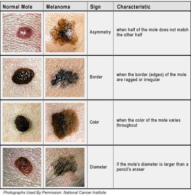 Skin Cancer - Integumentary system